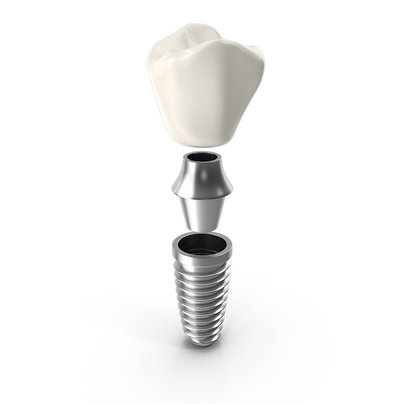 graphic of a dental implant