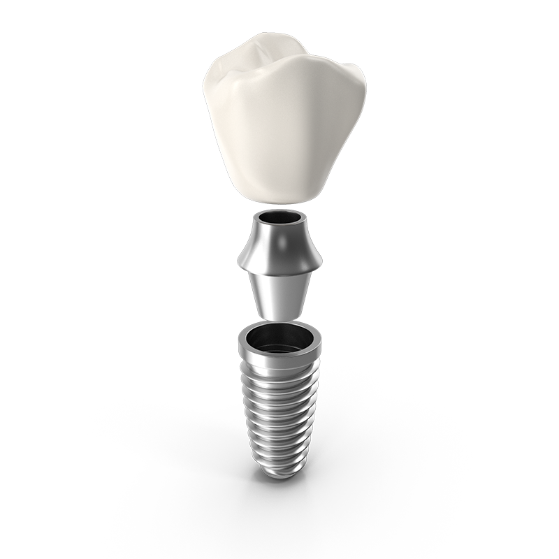 graphic of a dental implant