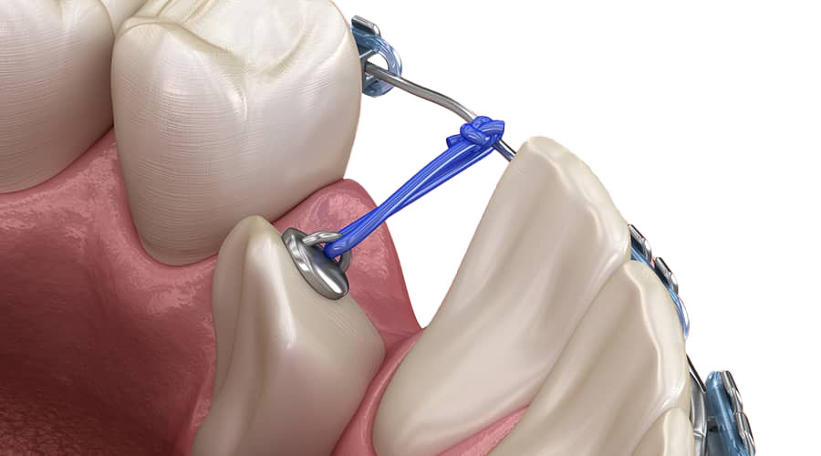 graphic of exposure and bond
