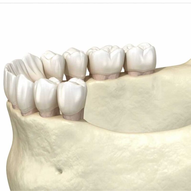 Graphic of bone grafting ridge