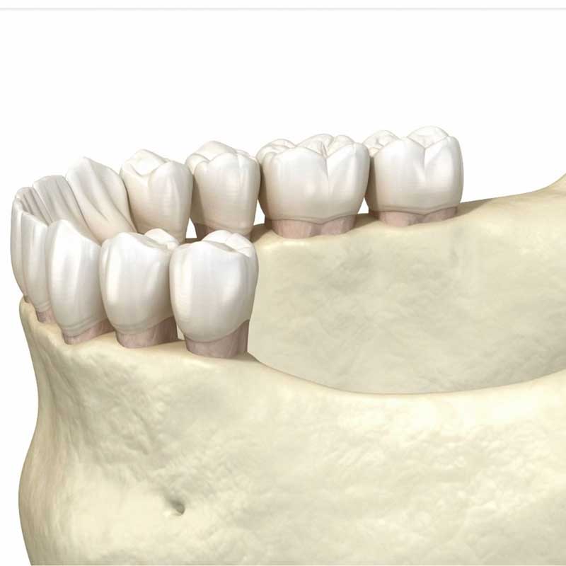 Ridge Augmentation Somverville & Lebanon NJ | Jaw Bone Reconstruction ...