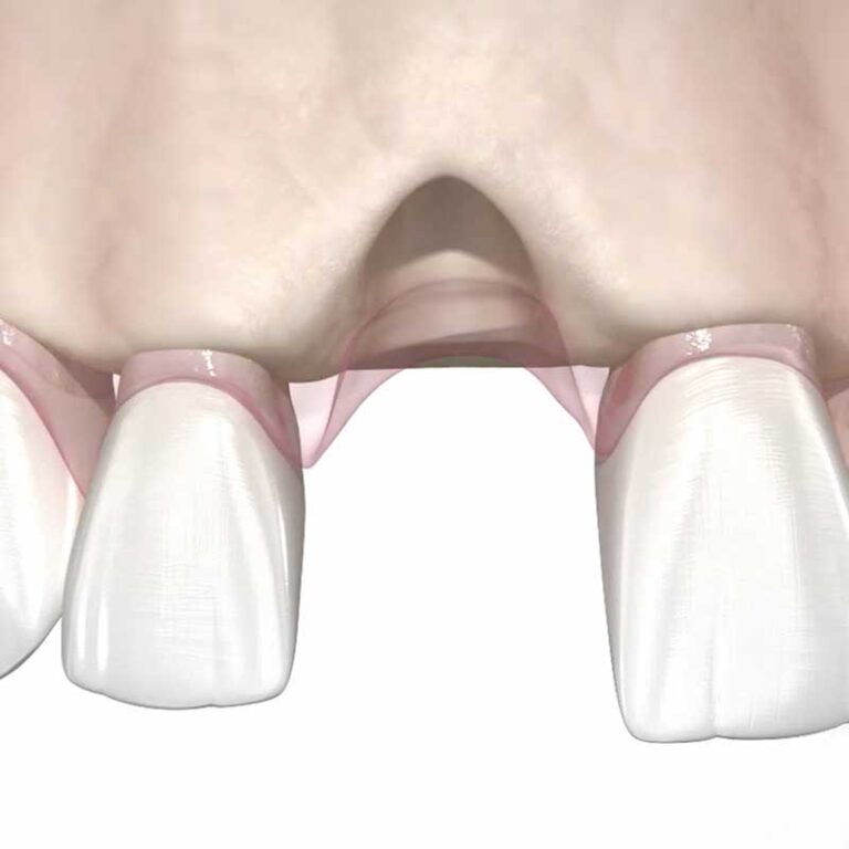 Image showing missing bone and tooth