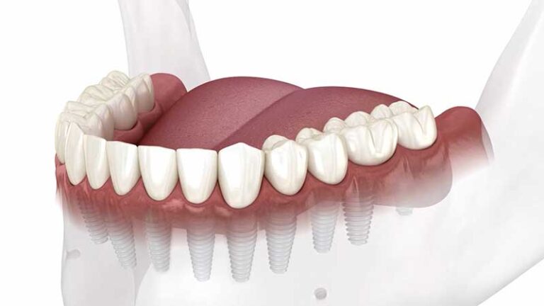 Graphic of individual lower dental implants