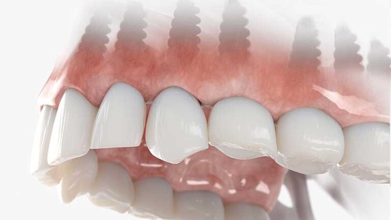 graphic of individual upper dental implants