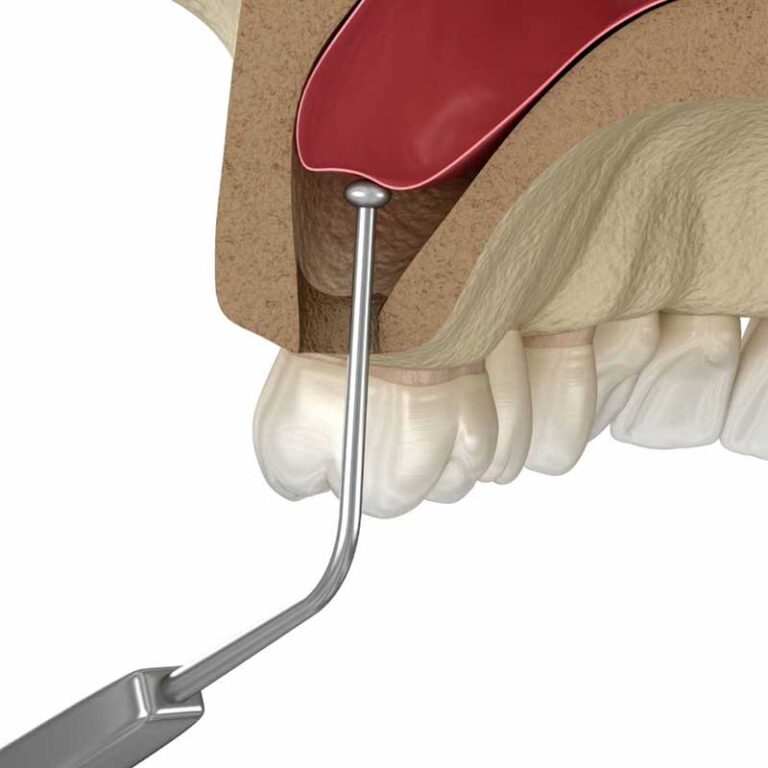 graphic of a sinus lift