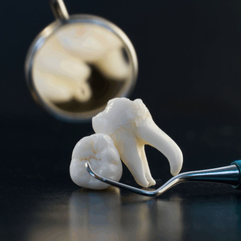 Wisdom Teeth Extraction